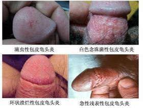 龟头上有红斑是怎么回事